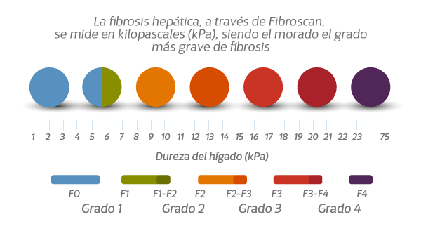 fibrosis en 4 etapas